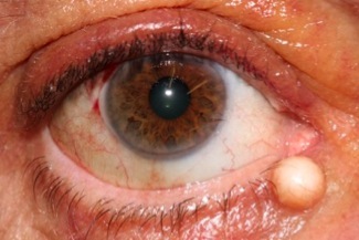 Eye Cyst